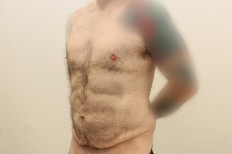 Abdominoplastie Pour Hommes Avant & Après Image