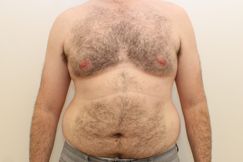 Abdominoplastie Pour Hommes Avant & Après Image