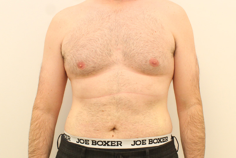 Abdominoplastie Pour Hommes Avant & Après Image