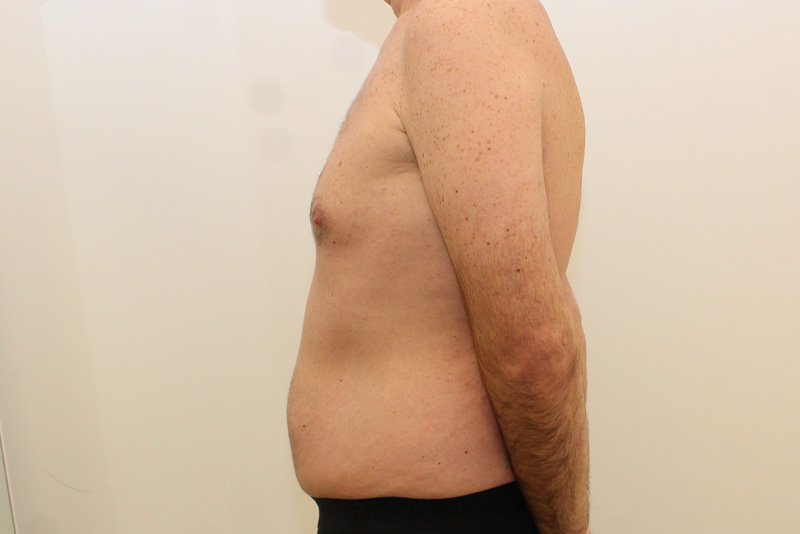 Abdominoplastie Pour Hommes Avant & Après Image