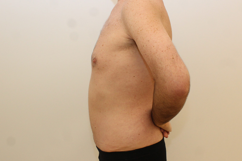 Abdominoplastie Pour Hommes Avant & Après Image