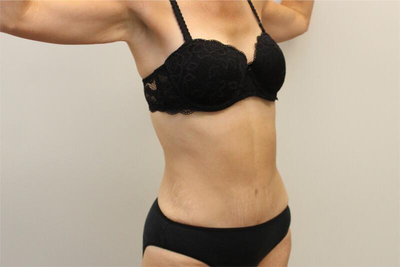 Abdominoplastie Before & After Image