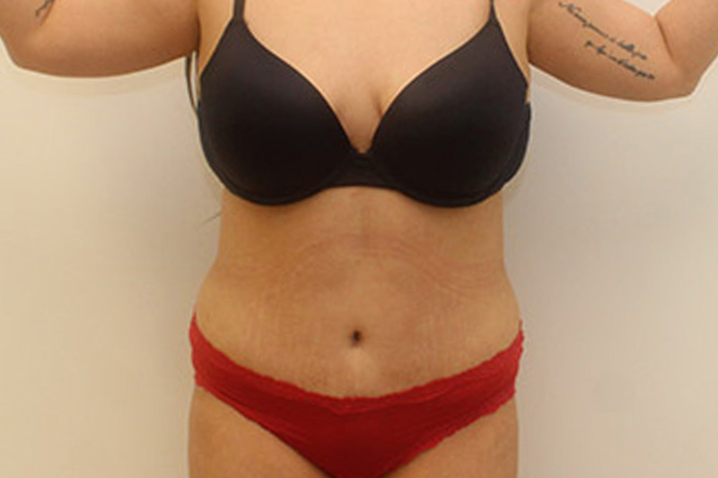 Abdominoplastie Avant & Après Image