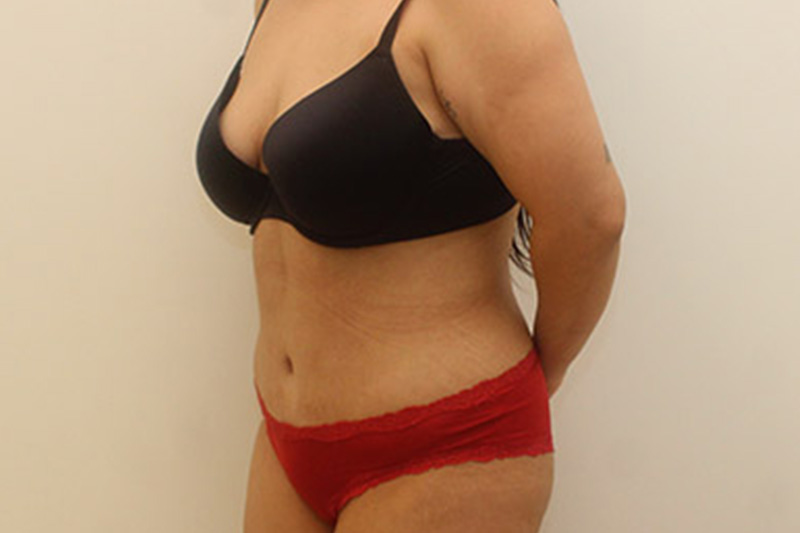 Abdominoplastie Avant & Après Image