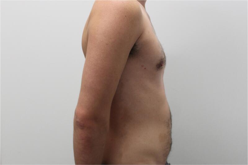 Gynecomastie Before & After Image