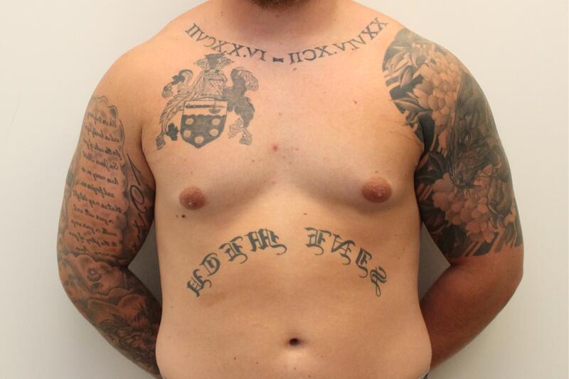 Gynecomastie Before & After Image