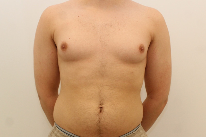 Gynecomastie Avant & Après Image