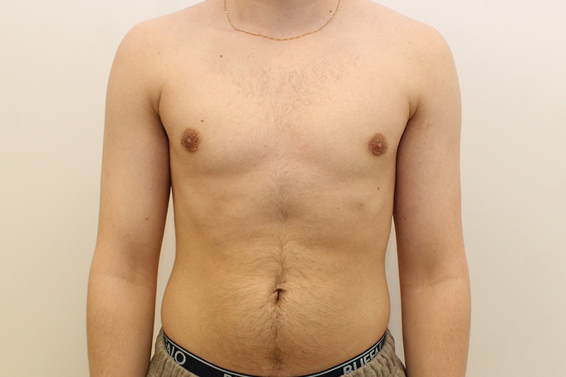 Gynecomastie Avant & Après Image