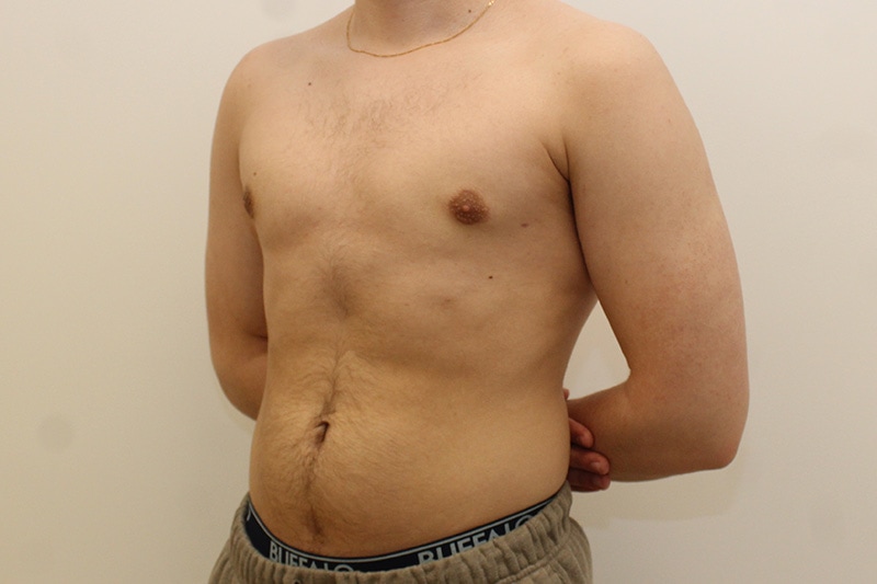 Gynecomastie Avant & Après Image