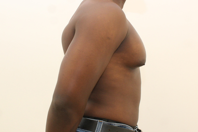 Gynecomastie Avant & Après Image