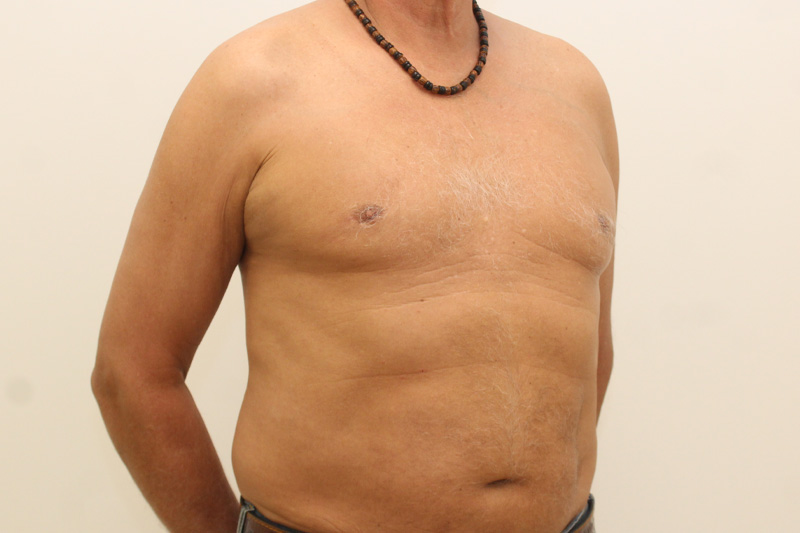 chirurgie de la gynécomastie Before & After Image