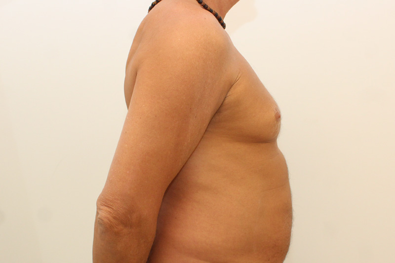 Gynecomastie Avant & Après Image