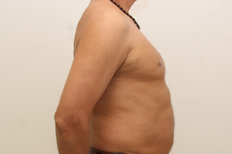 Gynecomastie Avant & Après Image