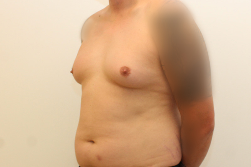 chirurgie de la gynécomastie Before & After Image
