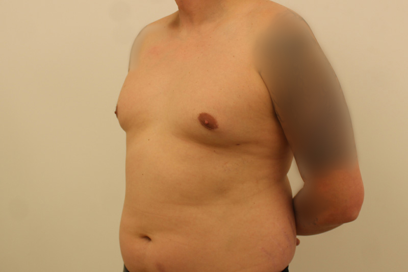 chirurgie de la gynécomastie Before & After Image