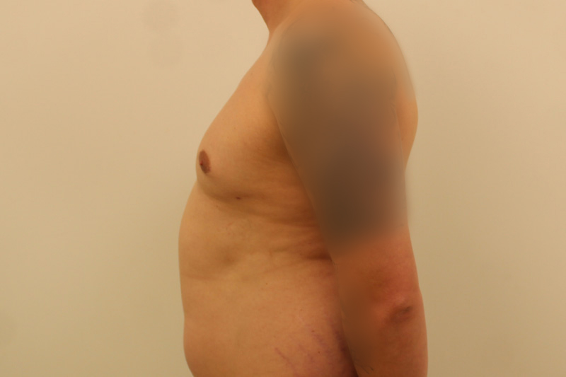 Gynecomastie Avant & Après Image