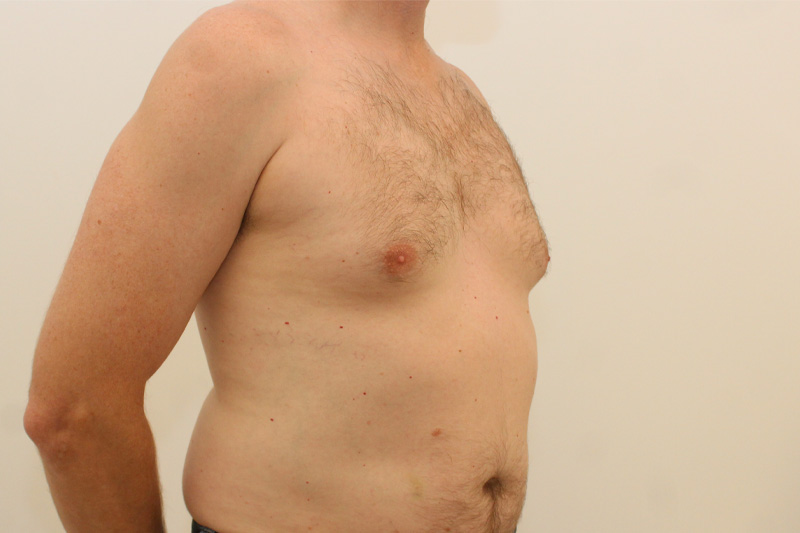 chirurgie de la gynécomastie Before & After Image