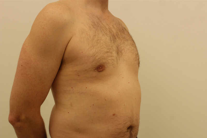 chirurgie de la gynécomastie Before & After Image