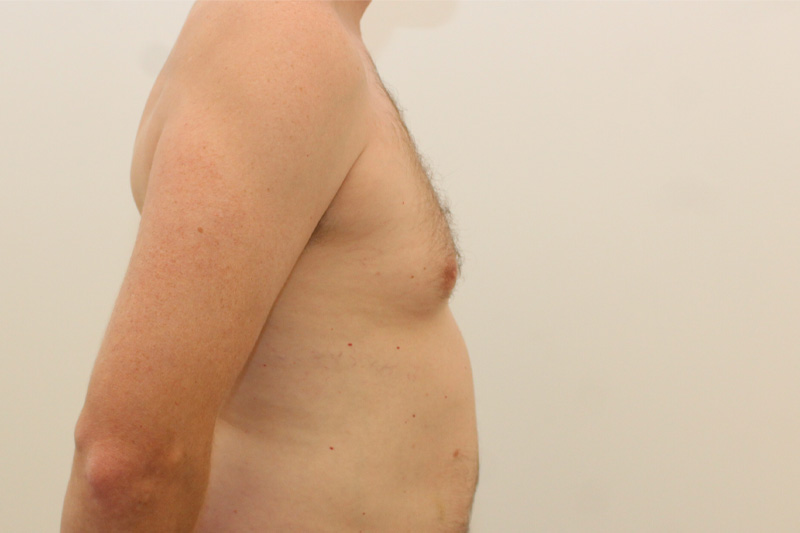 Gynecomastie Avant & Après Image