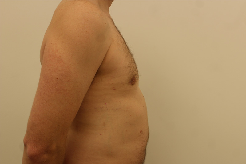 Gynecomastie Avant & Après Image