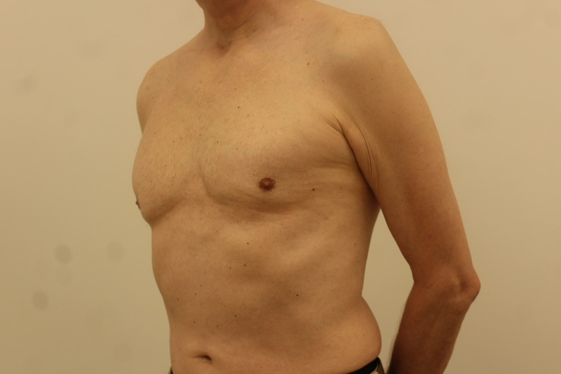 chirurgie de la gynécomastie Before & After Image