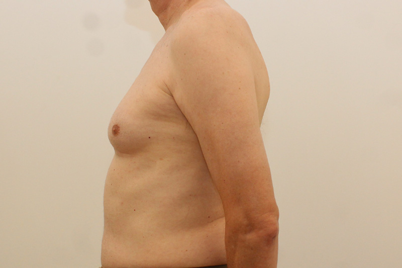 Gynecomastie Avant & Après Image