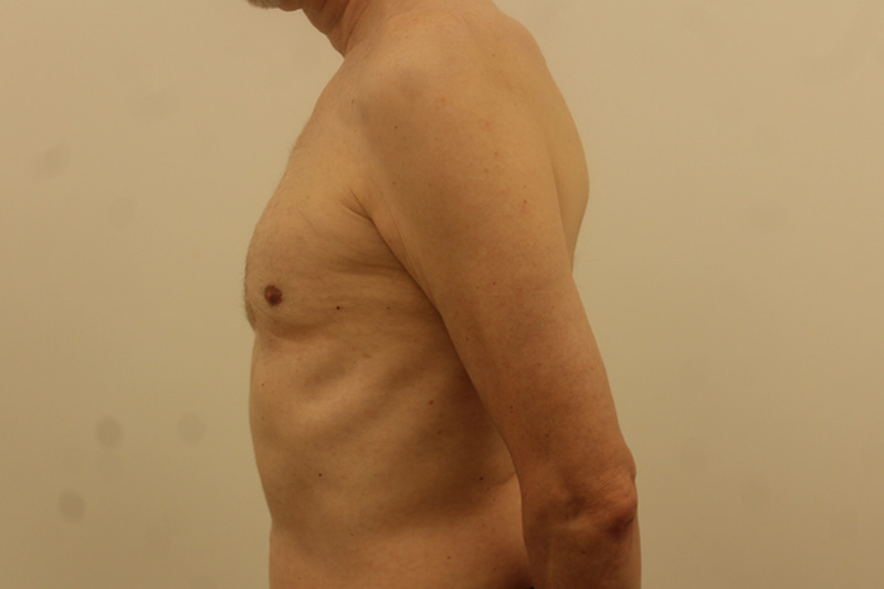 Gynecomastie Avant & Après Image