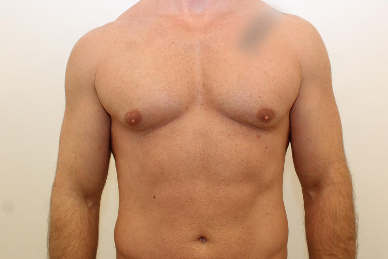 chirurgie de la gynécomastie Before & After Image
