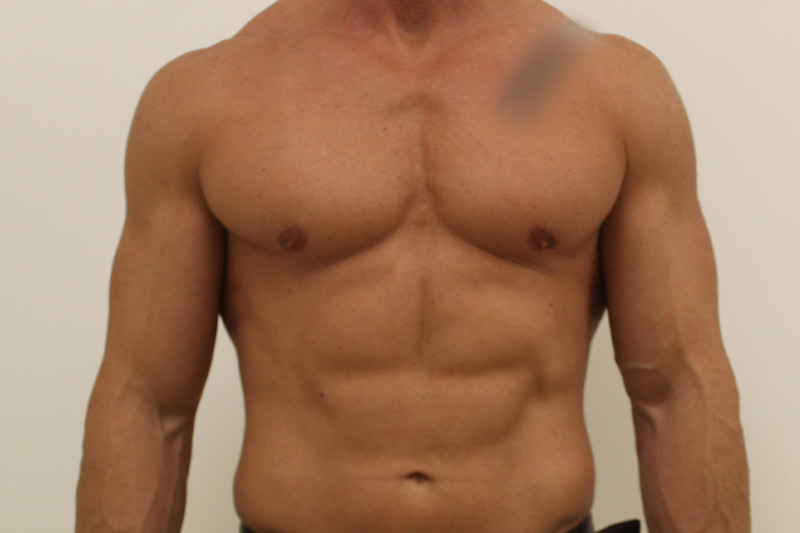 chirurgie de la gynécomastie Before & After Image