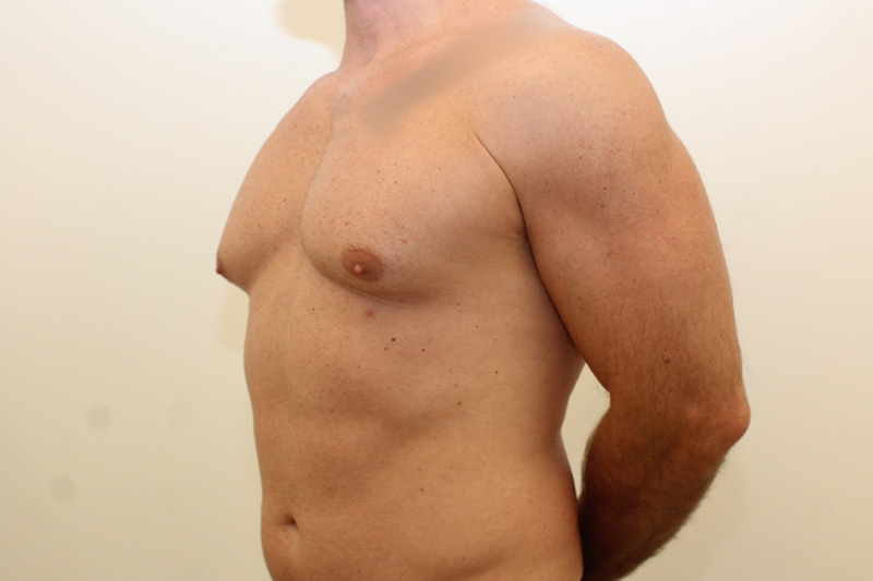 Gynecomastie Avant & Après Image