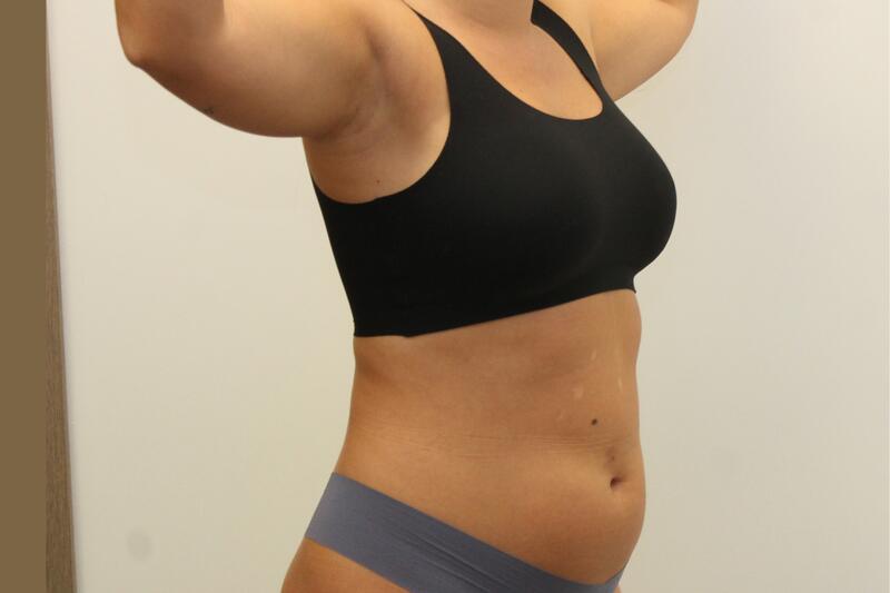 Liposuccion Before & After Image