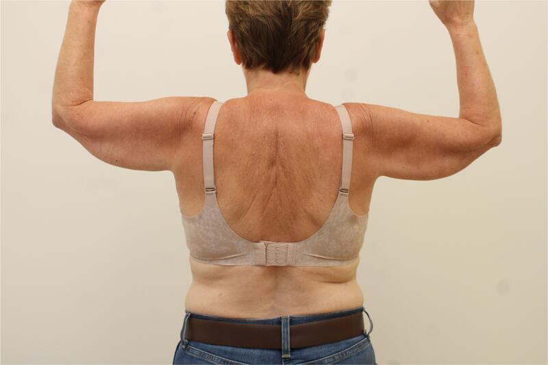 Redrapage Des Bras Before & After Image