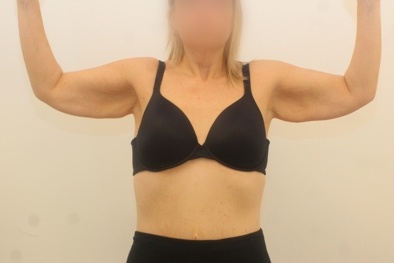 redrapage des bras Before & After Image