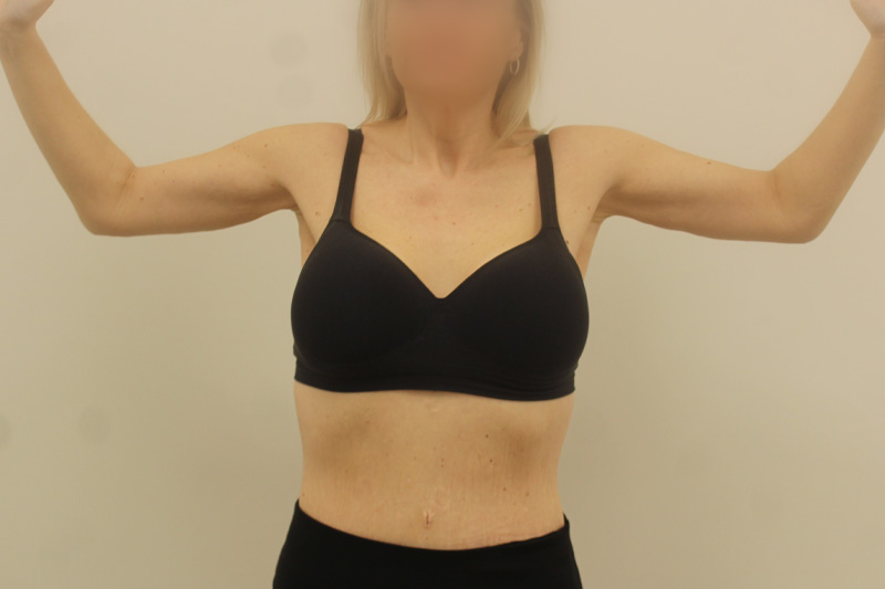 redrapage des bras Before & After Image