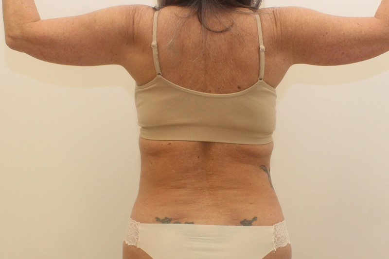 Renuvion Avant & Après Image