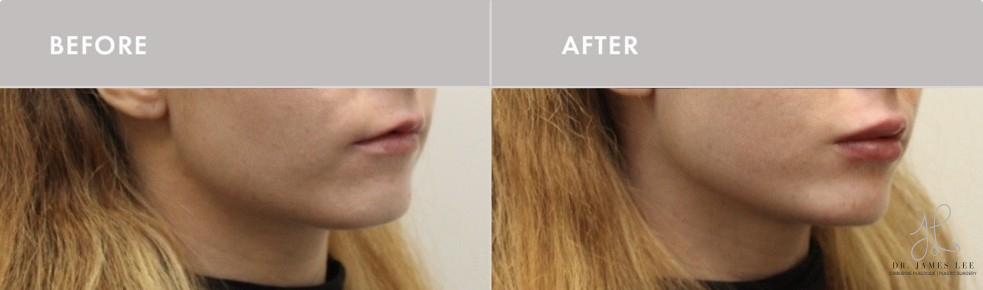 Agent de comblement Before & After Image