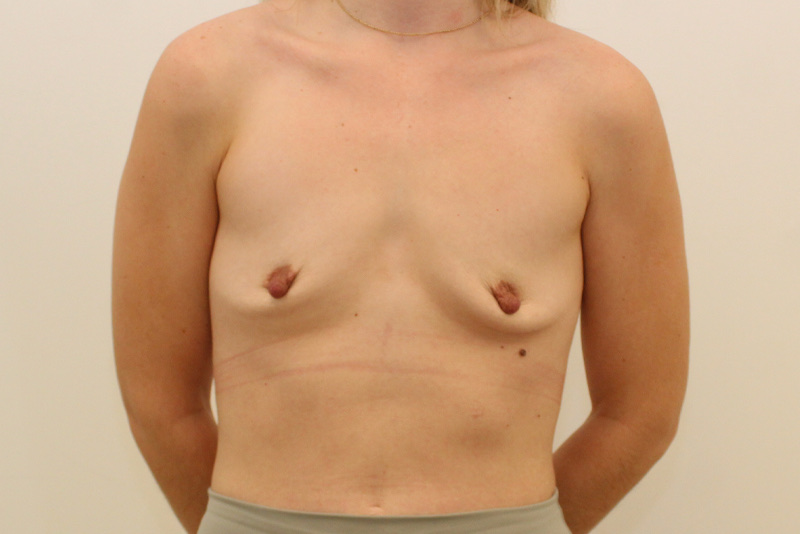 Augmentation Mammaire Avant & Après Image