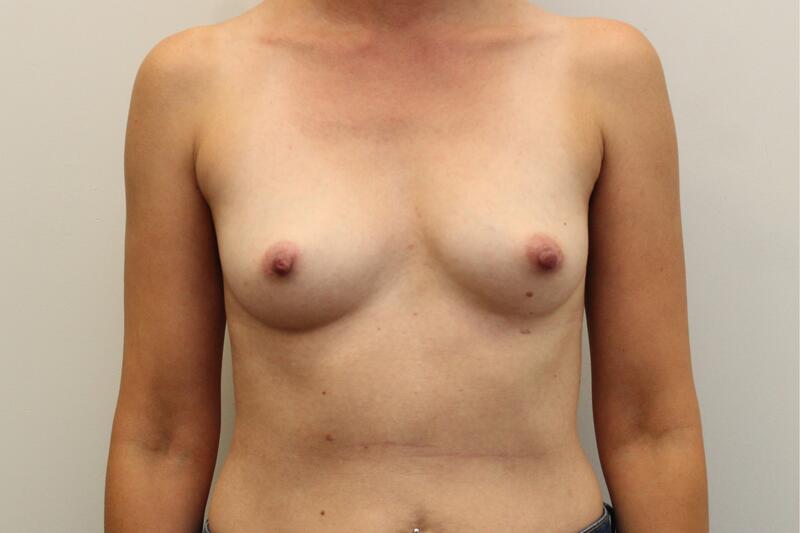 Augmentation Mammaire Before & After Image