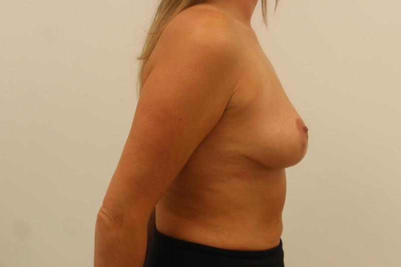 Mastopexie et Augmentation Avant & Après Image