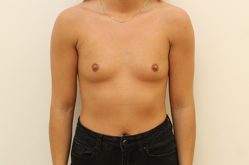 Échange D'Implants Avant & Après Image