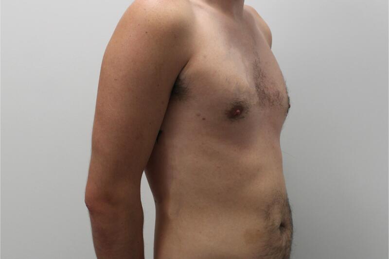 Gynecomastia Before & After Image