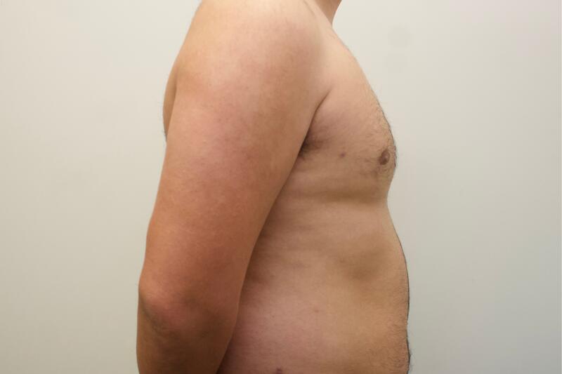 Gynecomastia Before & After Image