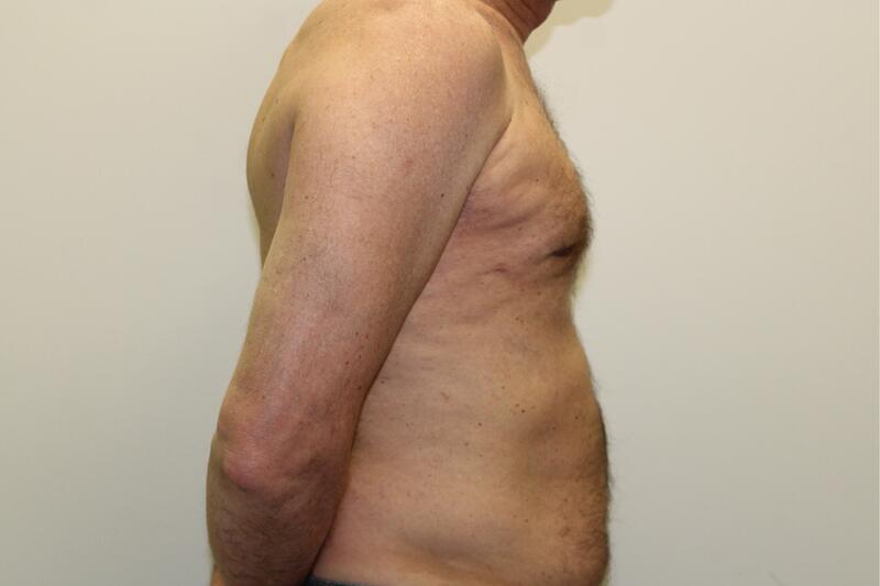 Gynecomastia Before & After Image