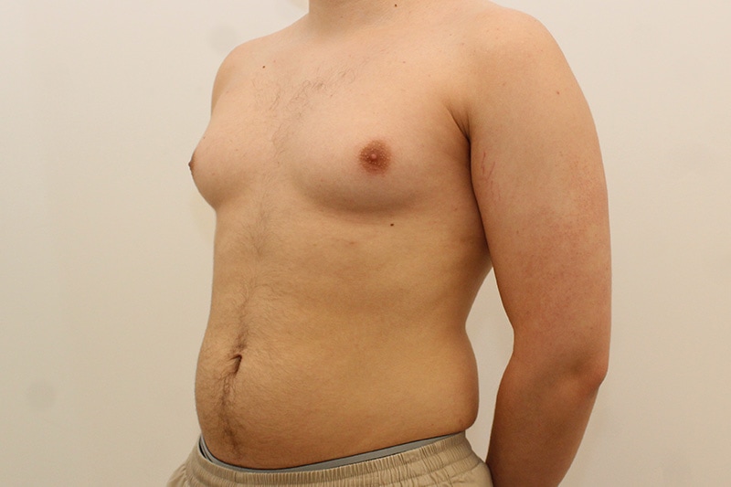 Gynecomastia Before & After Image