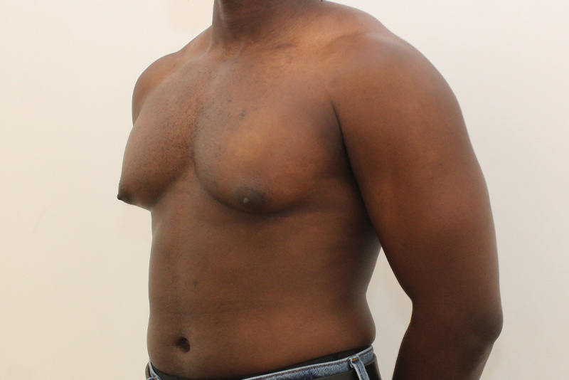 gynecomastia male breast reduction Before & After Image