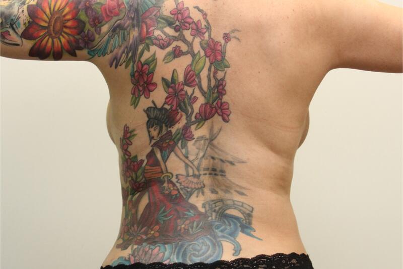 Liposuction Before & After Image