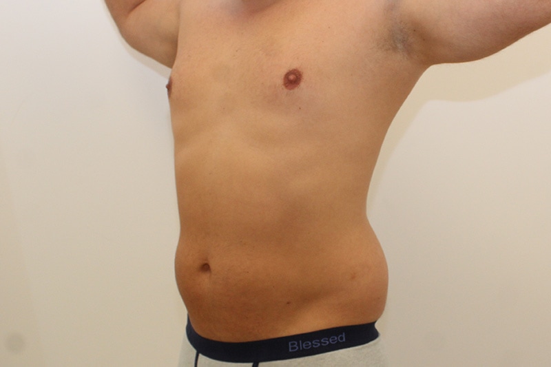 Liposuction Before & After Image