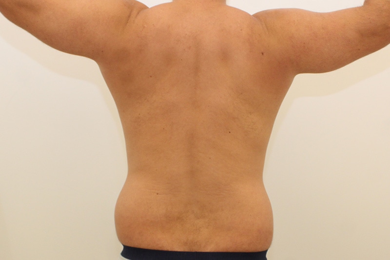 Liposuction Before & After Image