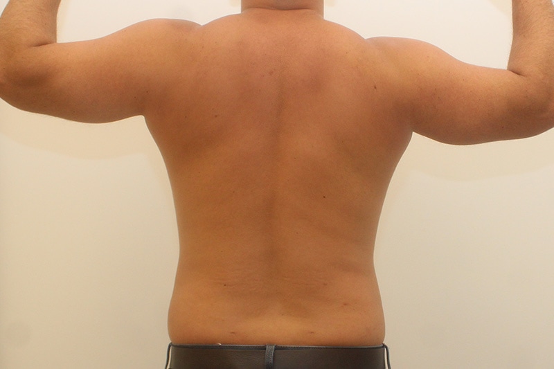Liposuction Before & After Image