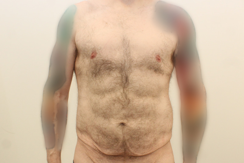Male Tummy Tuck Before & After Image